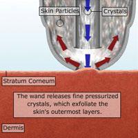 Microdermabrasion Procedure - Part II The hand piece releases fine, pressurized crystals, which much like sandblasting exfoliate the stratum corneum, or the skin's outermost layer.