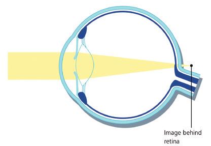 WHAT PROBLEMS DOES LASER EYE SURGERY FIX? Image in front of retina Myopia (near-sightedness) Myopia is the most common focusing problem treated by laser eye surgery.