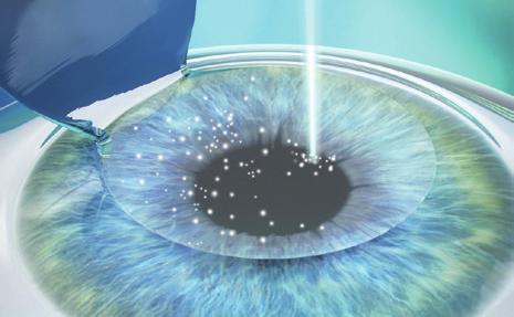 create microscopic bubbles under the surface of the cornea.