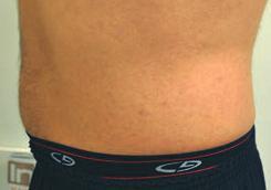 The core applicator treats the abdomen and flanks while the FLEX applicator reduces unwanted fat on the upper legs.
