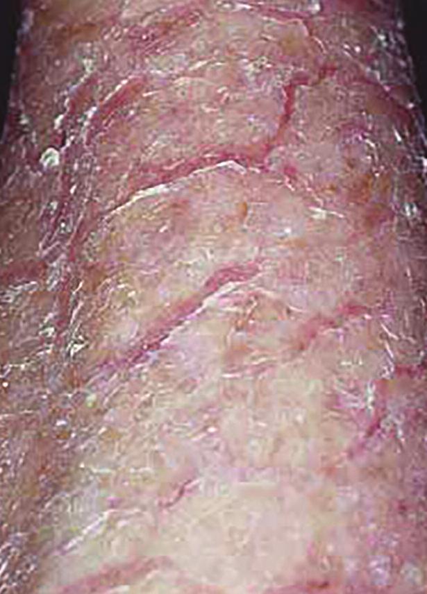 Ichthyosis Ichthyosis describes a group of long-term conditions in which the skin is dry and scaly. The word ichthyosis comes from the Greek words meaning fish and disease.