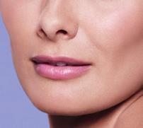 Allergan Product Surveillance at 1-800-624-4261. For more information, please see Juvederm.