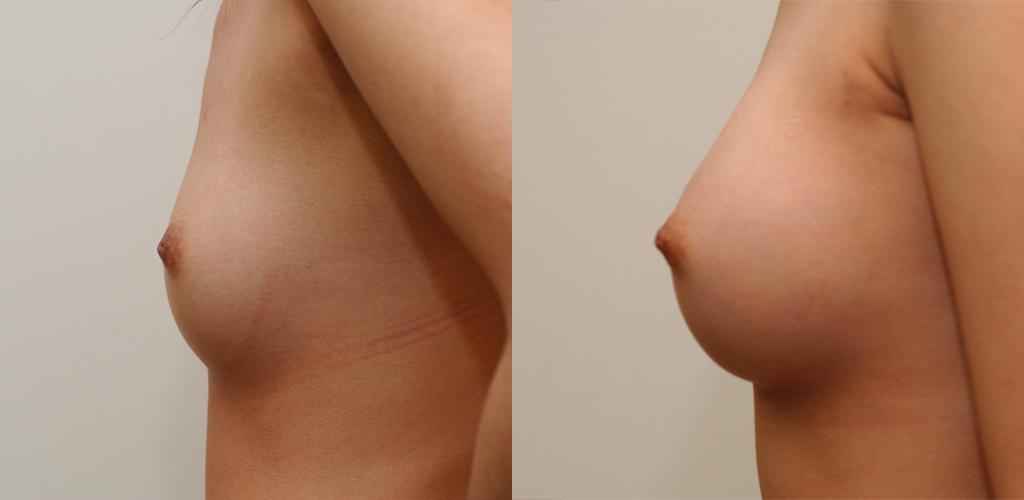 b&a breast surgery /