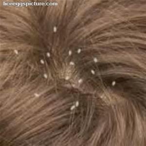 What are Head lice? The head louse is an insect that attaches itself to the scalp and feeds off human blood.