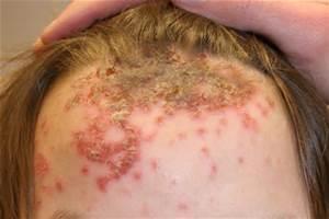 Head lice allergies If you develop an allergic