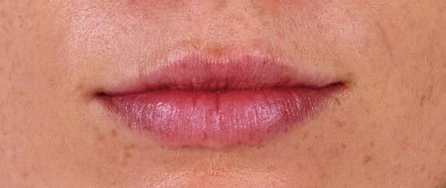 2 ml of JUVÉDERM Ultra XC was ijected ito the lips. JUVÉDERM Ultra XC is the first filler prove to last up to 1 year i the lips.