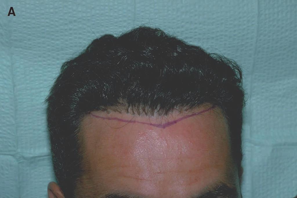 Dermatol Surg 28:10:October 2002 bernstein et al.: the art of repair 883 Figure 4. A) Very pluggy frontal hairline from an old punch-graft technique.