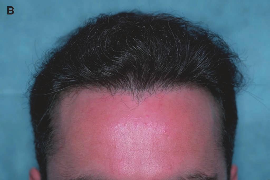 and avoid making these rather isolated grafts appear unnatural. This tacking helps to keep the longer frontal hairs in place during routine activities, and in the wind.