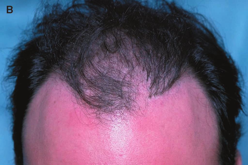 C) The dense, linear row of plugs was successfully camouflaged in just one session by using larger, closely spaced follicular units on the part side of the scalp.