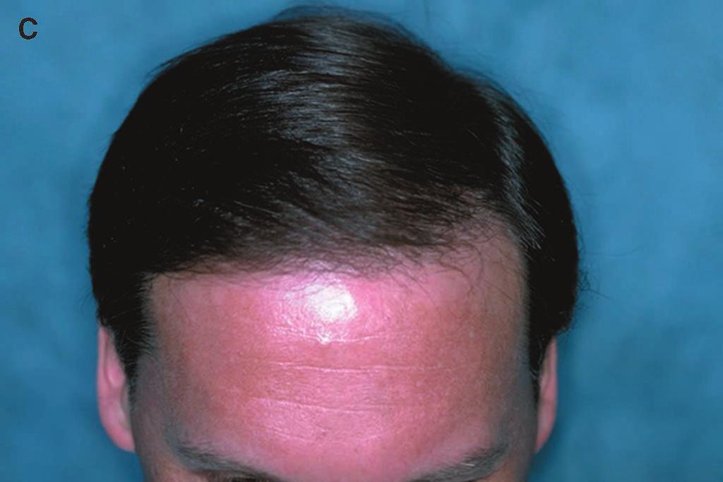 For this reason, follicular units should be placed in the normal skin in front of the hyperfibrotic change (if the position of the hairline permits) so that adequate camouflage can be ensured.