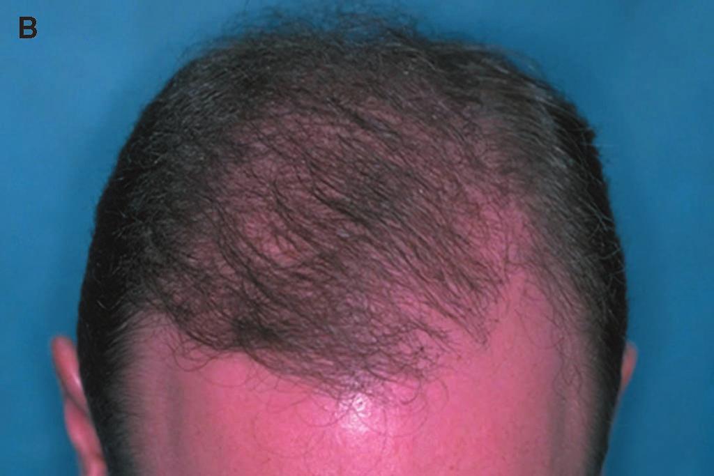 The procedures left significant scarring, a low donor density, and a tight scalp. B) The defect was camouflaged with a single procedure of 1825 follicular unit grafts. C) Frontal view before repair.