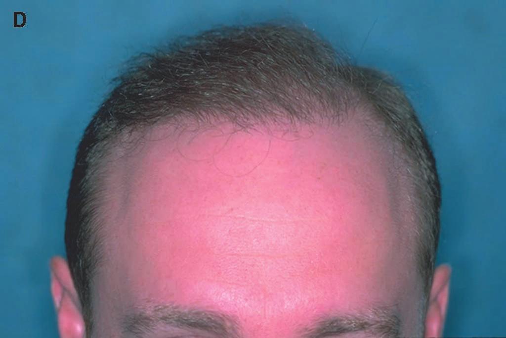 The single, split hairs should be placed at the very front edge of the hairline and temples at an angle so acute that it is practically flush with the skin surface.