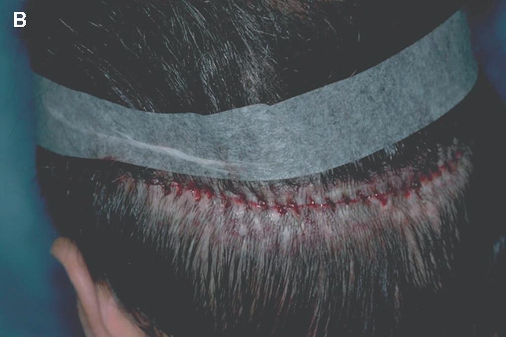 The hair within the scar tissue was dissected into individual follicular units and reimplanted. During the next procedure, the open-donor scars will be eliminated.