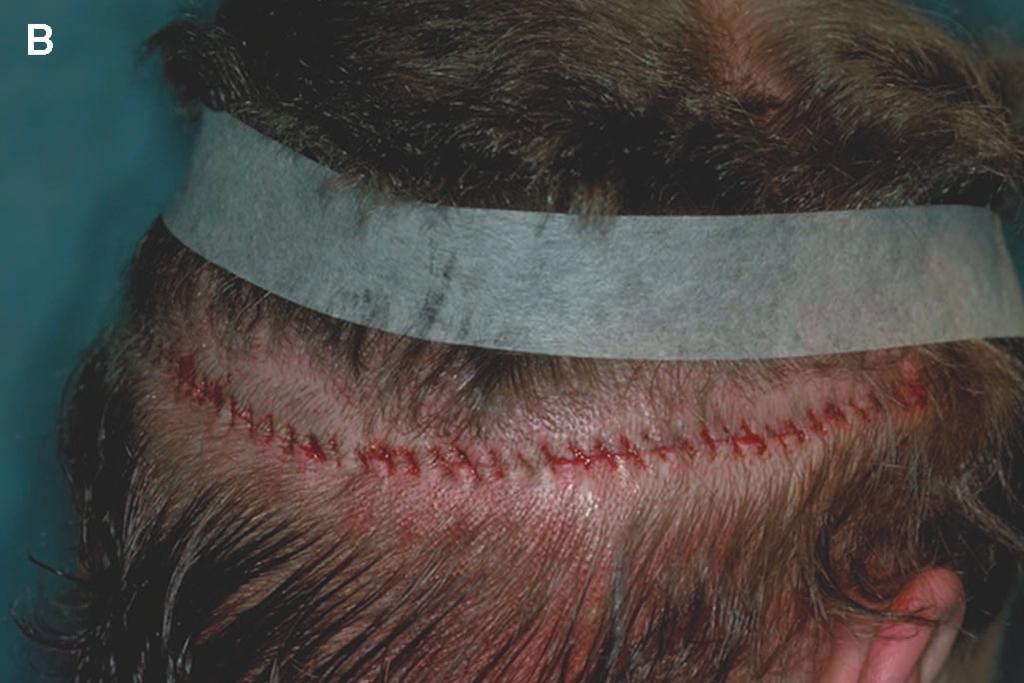 The issue of whether the additional wound security from suturing into a hair-bearing edge outweighs potential hair loss from the suturing itself should be decided on a case-by-case basis.