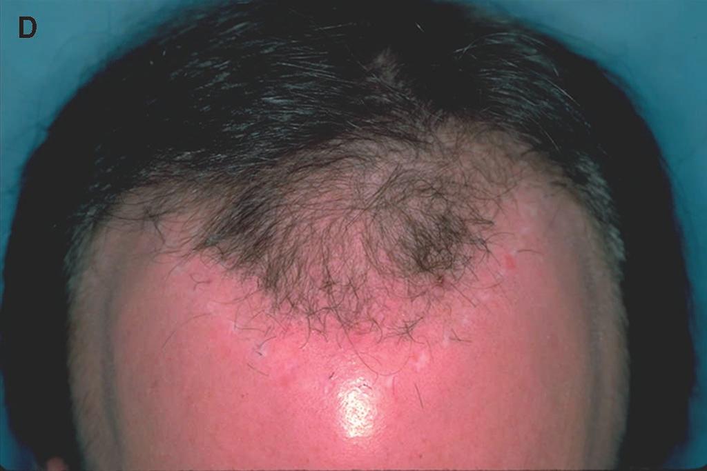 C) Sutured sites after the removal (note the hair retransplanted to the front edge of the old hairline).