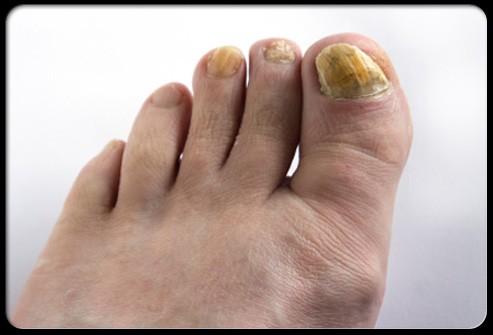 Ask your doctor to recommend a medication for athlete's foot. Athlete's foot is a fungus that causes itching, redness, and cracking.