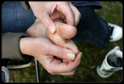 Blisters Wearing shoes that do not fit properly or wearing shoes without socks can cause blisters, which can become infected. When treating blisters, it's important not to "pop" them.
