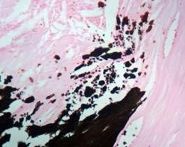 STAINS FOR PIGMENTS AND MINERAL STAIN COMPONENT STAINS CALCIUM VON KOSSA MINERALISED BONE