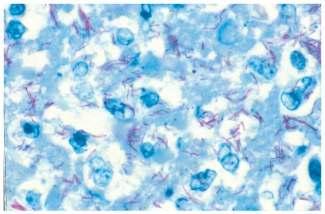 STAINS FOR MICROORGANISM STAINS COMPONENTS STAIN POSSIBLE USES ACID FAST BACILLI STAINS (ZIEHL NEELSEN, KINYOUN (COLD ZN)) WADE FITE MYCOBACTERIUM BRIGHT RED AND BEADED NOCARDIA