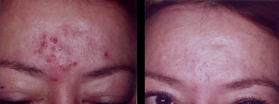 Acne Treatment blue (415nm) and revive (633nm) light alone Before