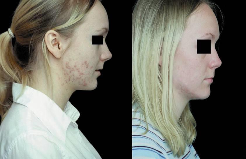 Acne Treatment blue (415nm) and revive (633nm) light alone Before treatment