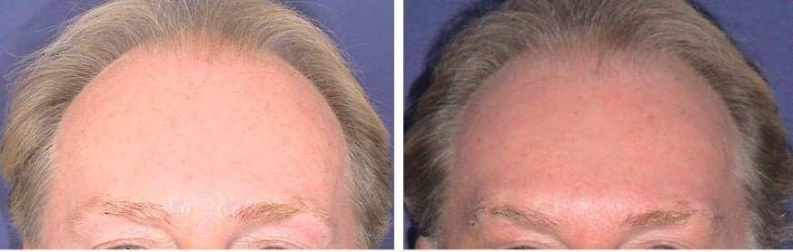 Serdev Sutures in Upper Face: Brow and Temporal Lift;
