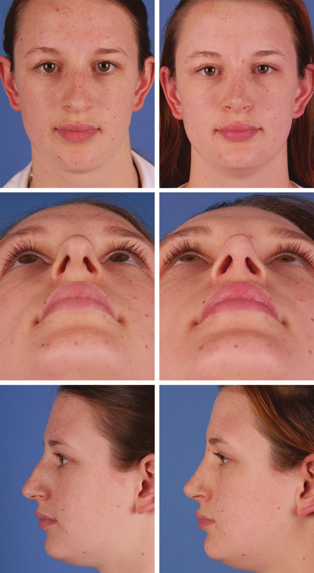 Plastic and Reconstructive Surgery October 2012 Fig. 5. Case 2: tension nose.