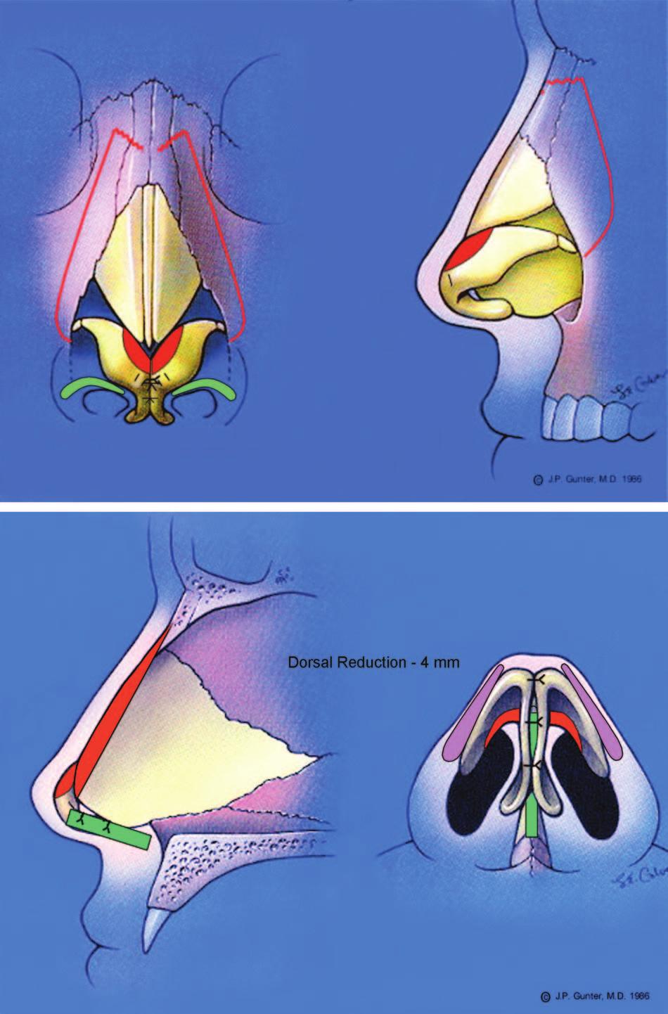 Volume 130, Number 4 Nasal Tip Position in Rhinoplasty Fig. 6. Case 2: tension nose. The nasal tracing. to be a tip translation.
