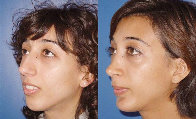 NON-SURGICAL RHINOPLASTY Some minor flaws actually don t require surgery and can be corrected quickly. Dr.