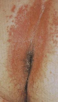 Management Candidiasis Characteristics Maculopapular rash that is solid in center with