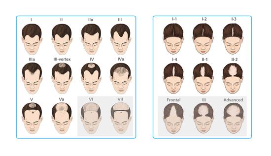 Applicable people identify figure Gray is not applicable to the crowd (hair loss level is too high, the hair follicles have