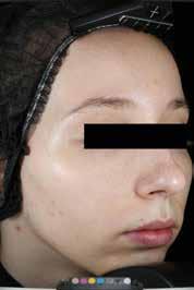 TARGET 2: Caucasian women (in 28 days) In caucasian skins non-inflammatory lesions are prevalent.