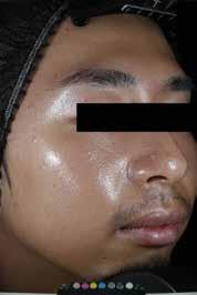 TARGET 3: Asian men D0 D28 29% Sebum reduction in only 2 weeks 17% Active sebaceous glands reduction in 28