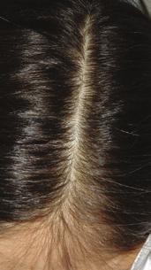 dermal matrix Prevent excessive hair loss Restore hair vitality Skin preparation before hair