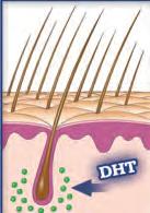 follicles are sensitive to D.H.T. (a primary cause of thinning and hair loss). Typically, hair on the top and front of the head is most sensitive to D.H.T. Over time, this hair will become weaker, finer and may eventually stop growing.