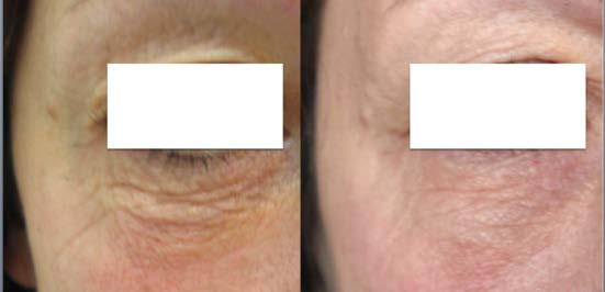 Figure 2. Before and after 6 sessions of EndyMed s ifine treatments. Significant improvement of texture, wrinkle reduction and tightening of the periorbital skin. Figure 3.