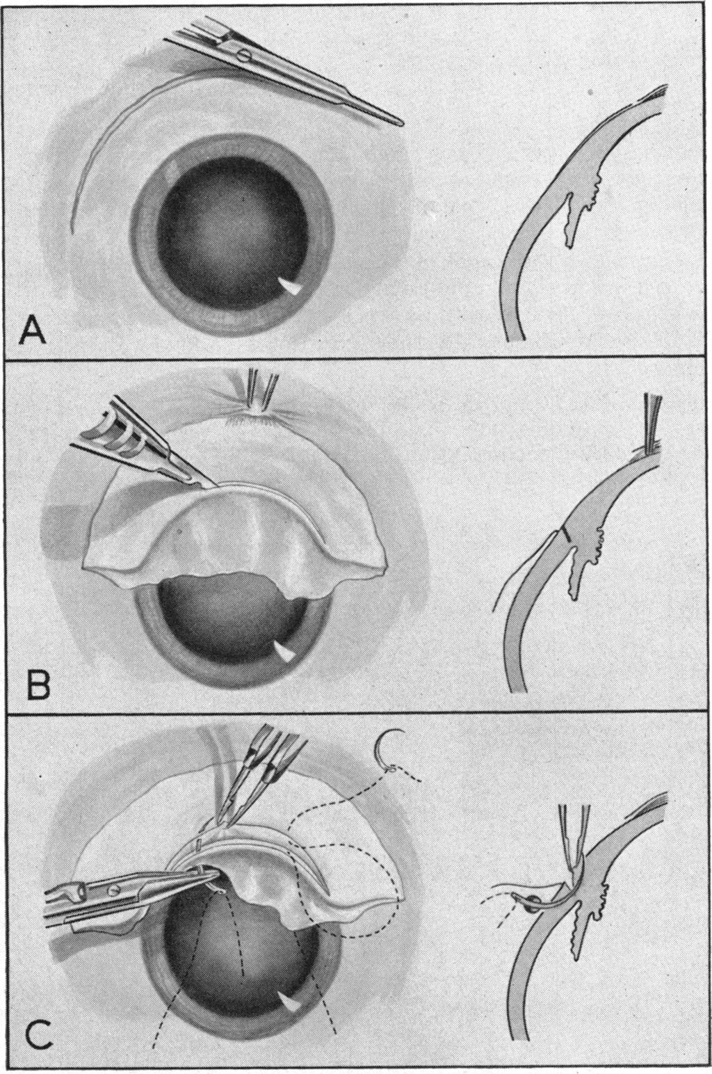 SCALPEL AND SCISSORS 515 Br J Ophthalmol: first published as 10.1136/bjo.43.9.513 on 1 September 1959. Downloaded from http://bjo.bmj.com/ the wound and not under the fibres forming the floor.