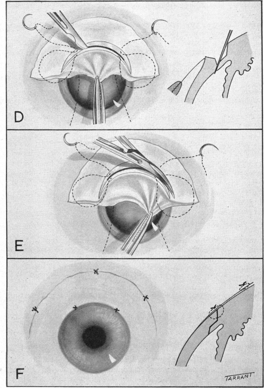 SCALPEL AND SCISSORS the central part of the incision and is made by a bold downward sweep of the scalpel which should cause an opening 5 to 6 mm. in extent (Fig. D).