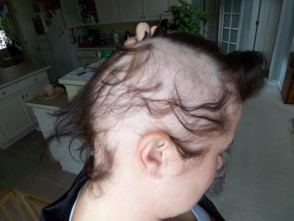 ALOPECIA Is the partial or complete absence of hair from areas of the body where it normally