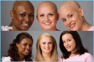 WHAT CAN YOU DO There are many charities that help make wig for lots of people suffering from hair loss no matter what the cause.