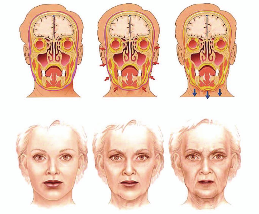 Figure 1. Coronal sections illustrating the loss of facial fullness that occurs with age.