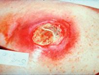 Infected Wound Description: highly colonized, wound with granulation tissue; moderate drainage Description: wound with necrotic tissue;