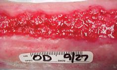 Granulating Description: Pink-red, firm, moist, viable granulating tissue Exudate Level: Depth: Treatment Objective: None to Moderate Unknown