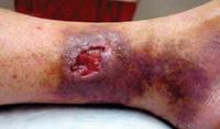 Venous Stasis Ulcer Description: Venous ulcers on lower extremity; increased discoloration; uneven edges; dry scaly skin; palpable pulse; edema present Exudate Level: