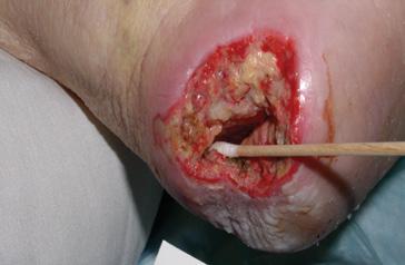 Heel Ulcer Description: Stage IV heel ulcer that probes to bone. There is yellow tissue present in wound bed; slight erythema & maceration noted along wound edges.