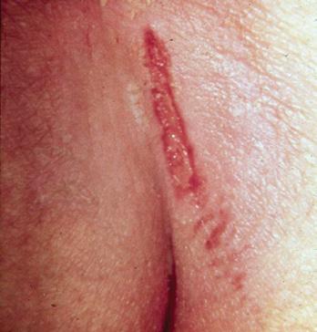 Definition: Partial thickness loss of dermis presenting as a shallow