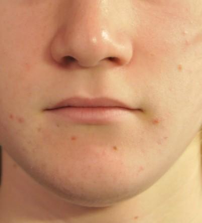 An acne spot fluid formulation containing 7.5% WORESANA concentrate was applied to the face of a 14-year old with blemished skin once a day for 21 days.