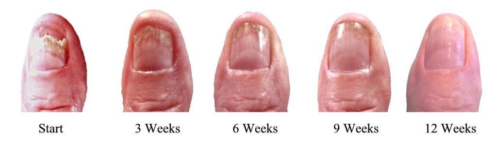 Relevant tests with 40% WORESANA serum in the form of a nail care preparation show this impressively.