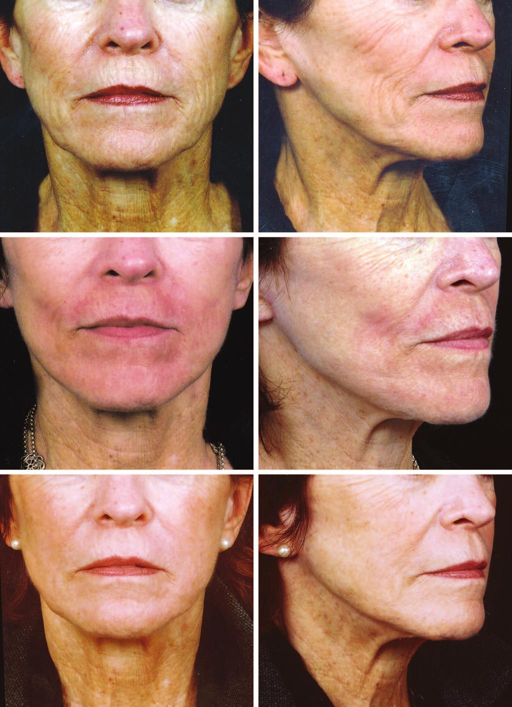 Volume 122, Number 5 Cross-Cheek Depression Fig. 3. A 67-year-old woman before secondary anterior face lift and dermabrasion (above).