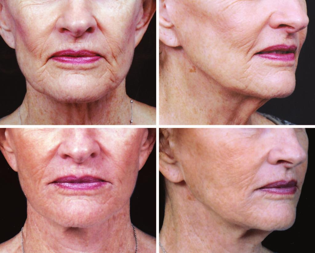 Plastic and Reconstructive Surgery November 2008 Fig. 8. (Above) A 75-year-old woman before a secondary face lift.
